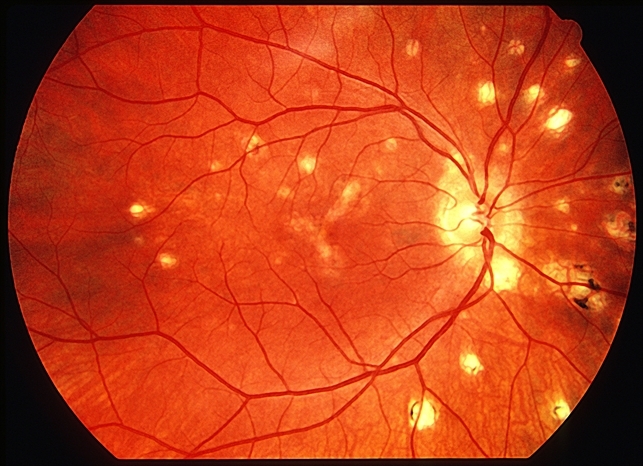 Diseases of the eye and adnexa 